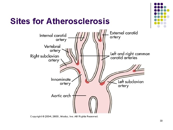 Sites for Atherosclerosis 33 