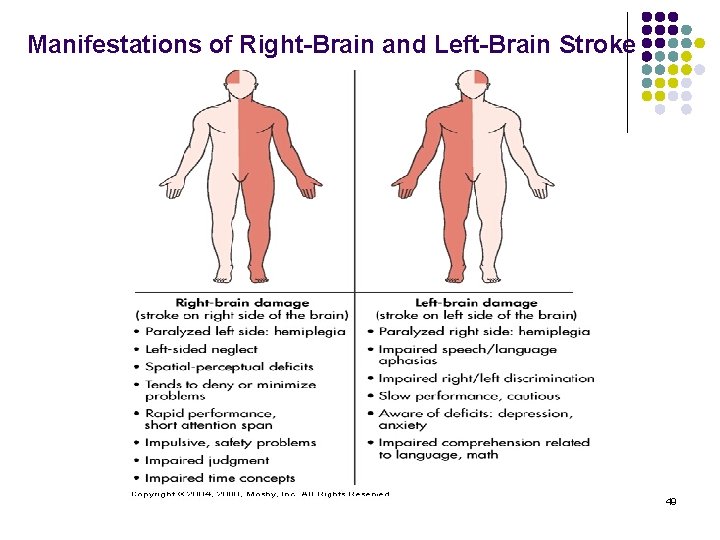 Manifestations of Right-Brain and Left-Brain Stroke 49 