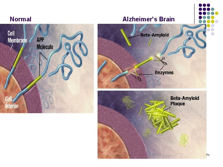 Normal Alzheimer’s Brain 71 