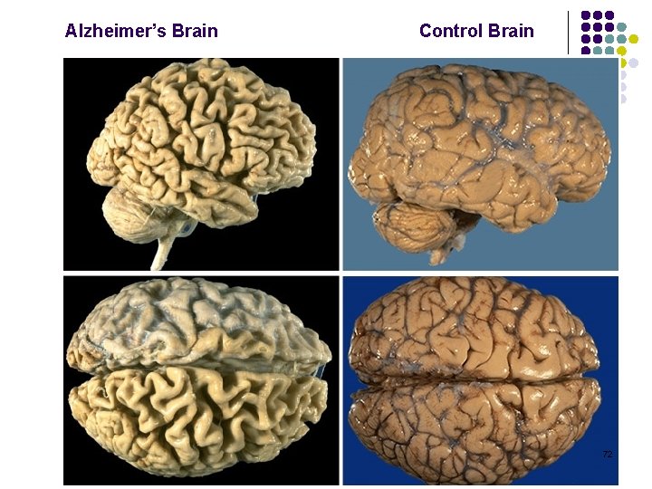 Alzheimer’s Brain Control Brain 72 