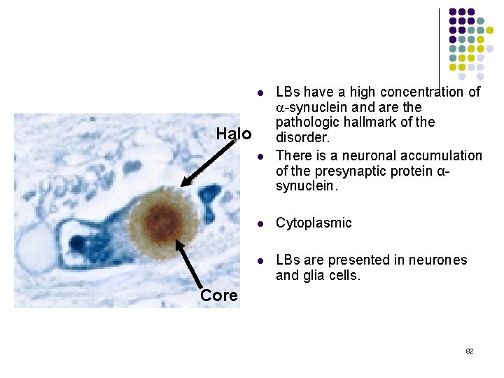 l Halo l LBs have a high concentration of a-synuclein and are the pathologic