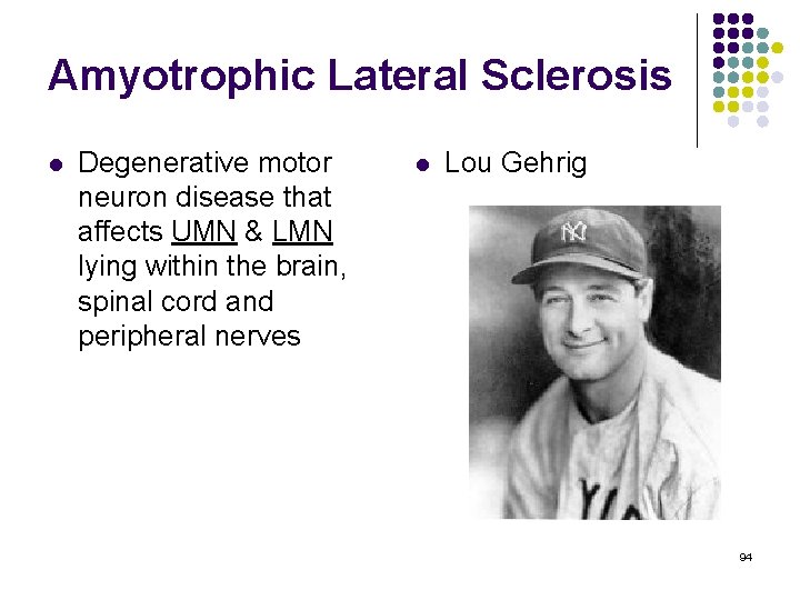 Amyotrophic Lateral Sclerosis l Degenerative motor neuron disease that affects UMN & LMN lying