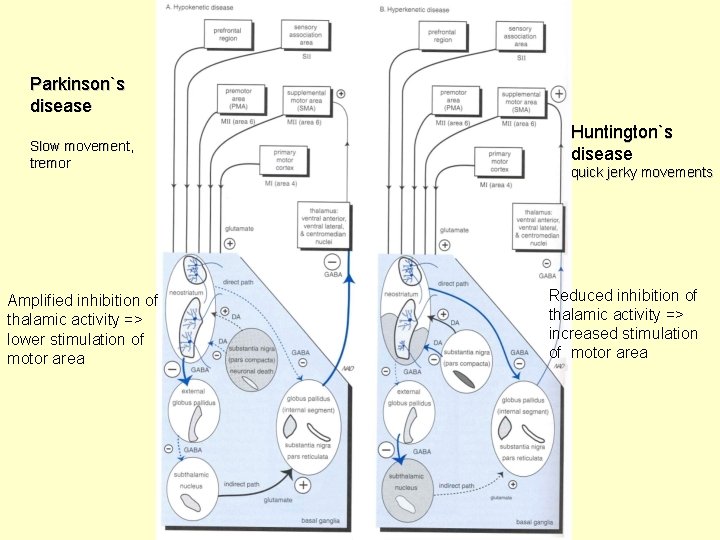 Parkinson`s disease Slow movement, tremor Amplified inhibition of thalamic activity => lower stimulation of