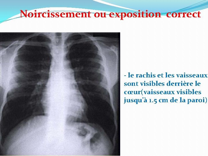 Noircissement ou exposition correct - le rachis et les vaisseaux sont visibles derrière le