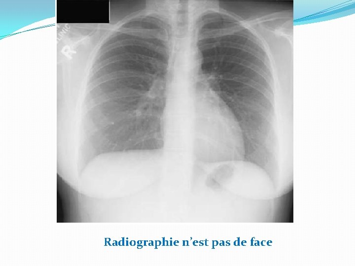 Radiographie n’est pas de face 
