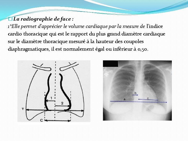 � La radiographie de face : 1*Elle permet d'apprécier le volume cardiaque par la