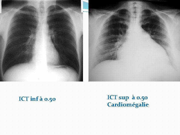ICT inf à 0. 50 ICT sup à 0. 50 Cardiomégalie 