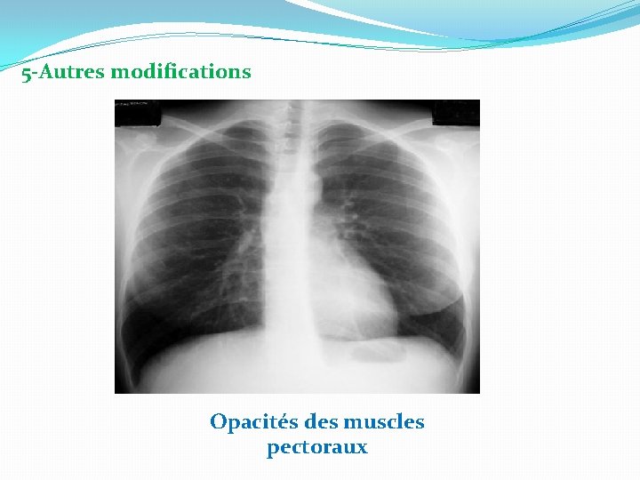 5 -Autres modifications Opacités des muscles pectoraux 