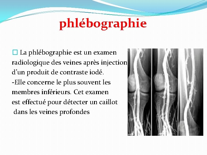 phlébographie � La phlébographie est un examen radiologique des veines après injection d’un produit