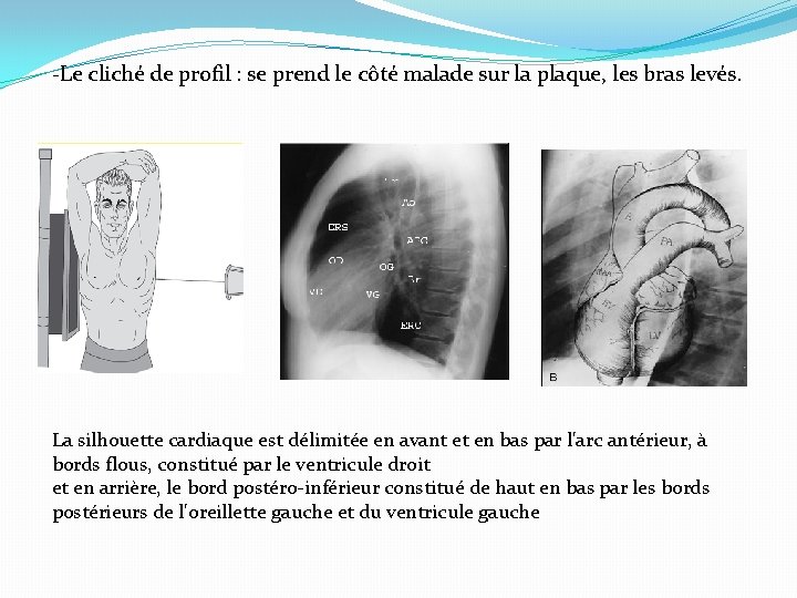 -Le cliché de profil : se prend le côté malade sur la plaque, les