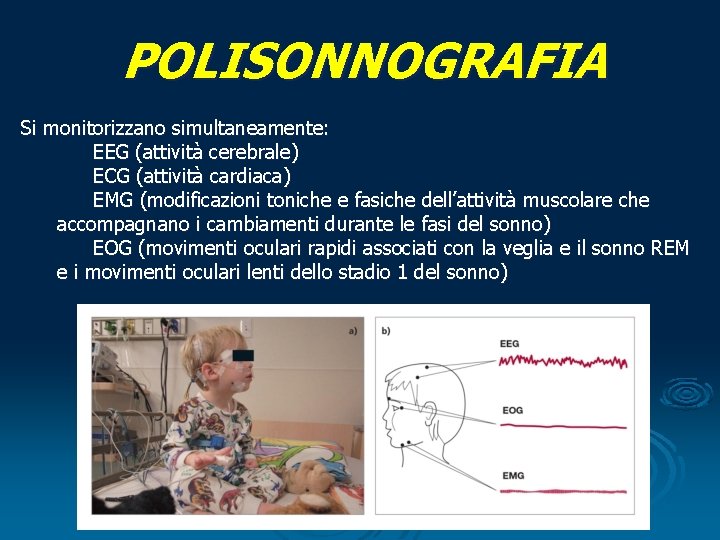 POLISONNOGRAFIA Si monitorizzano simultaneamente: EEG (attività cerebrale) ECG (attività cardiaca) EMG (modificazioni toniche e