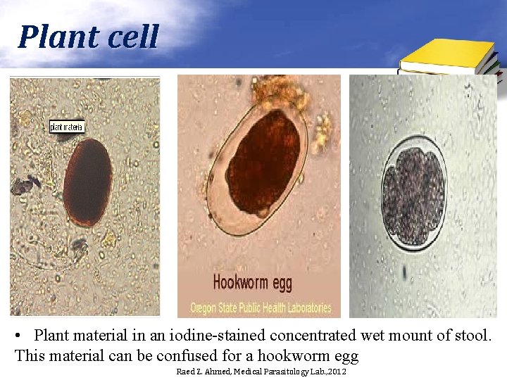 Plant cell • Plant material in an iodine-stained concentrated wet mount of stool. This