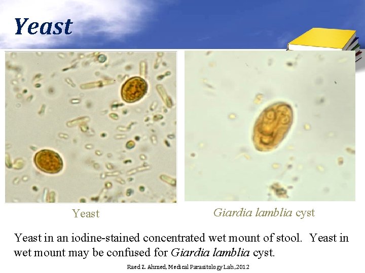 Yeast Giardia lamblia cyst Yeast in an iodine-stained concentrated wet mount of stool. Yeast