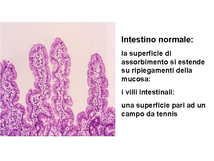 Intestino normale: la superficie di assorbimento si estende su ripiegamenti della mucosa: i villi