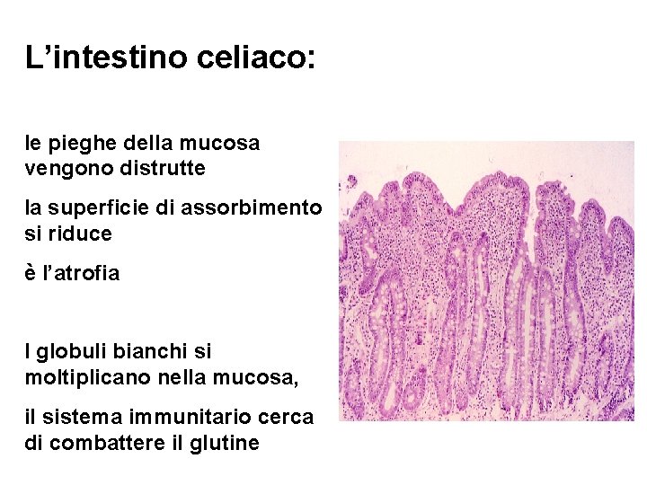 L’intestino celiaco: le pieghe della mucosa vengono distrutte la superficie di assorbimento si riduce
