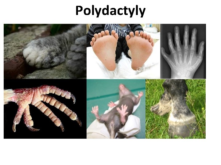 Polydactyly 