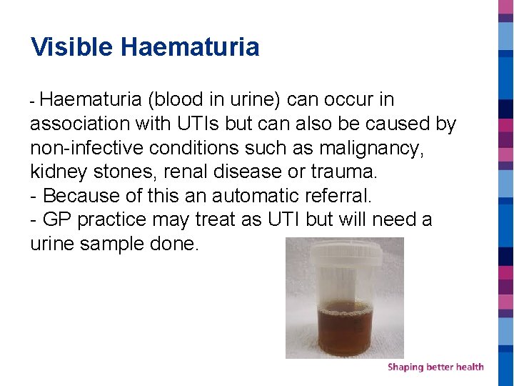 Visible Haematuria - Haematuria (blood in urine) can occur in association with UTIs but