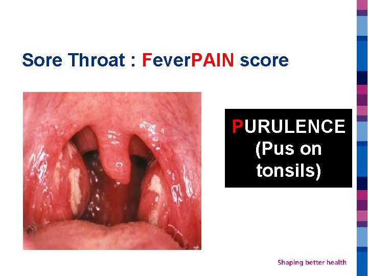 Sore Throat : Fever. PAIN score PURULENCE (Pus on tonsils) 