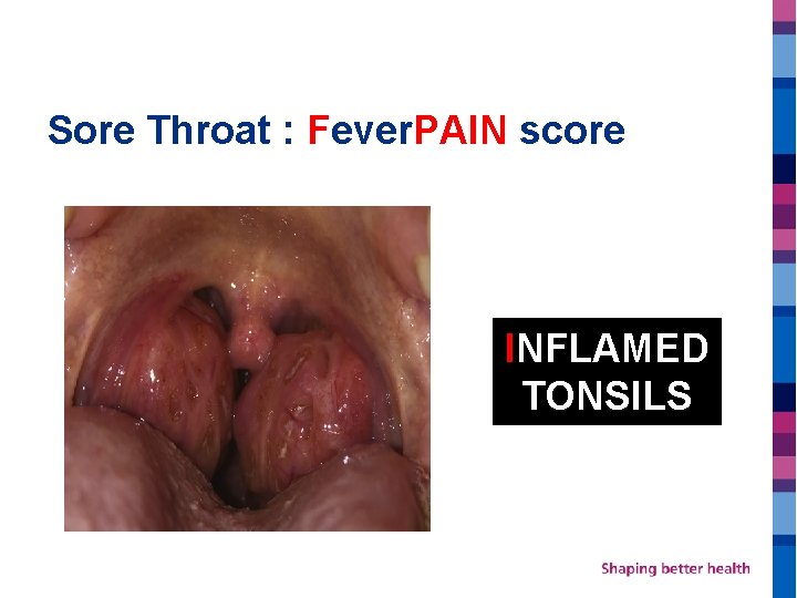 Sore Throat : Fever. PAIN score INFLAMED TONSILS 