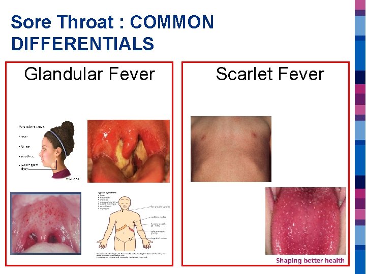 Sore Throat : COMMON DIFFERENTIALS Glandular Fever Scarlet Fever 