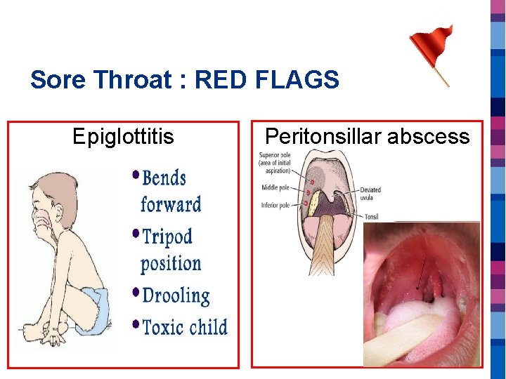 Sore Throat : RED FLAGS Epiglottitis Peritonsillar abscess 