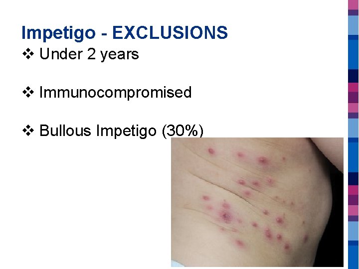 Impetigo - EXCLUSIONS v Under 2 years v Immunocompromised v Bullous Impetigo (30%) 