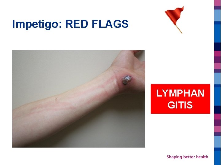 Impetigo: RED FLAGS LYMPHAN GITIS 