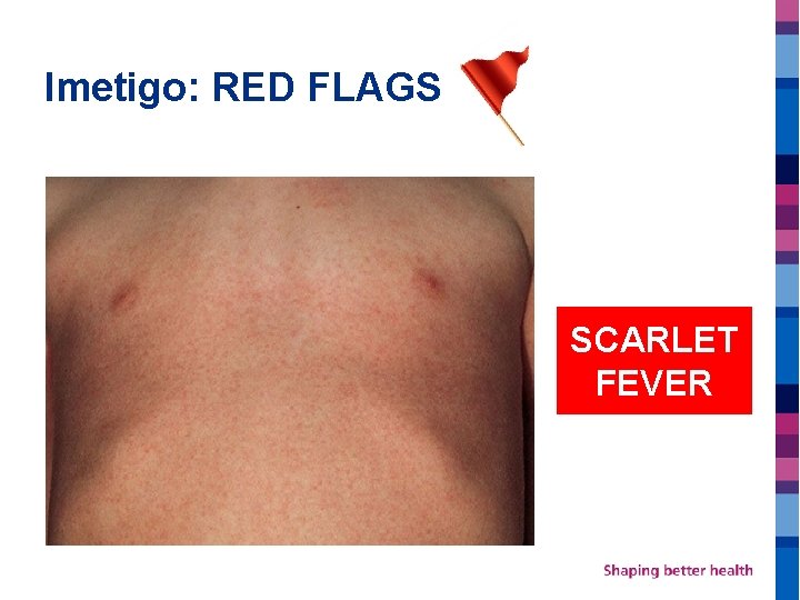 Imetigo: RED FLAGS SCARLET FEVER 