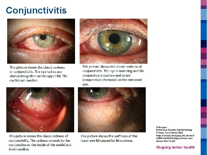 Conjunctivitis Reference : Bristol Eye Hospital Ophthalmology Primary Care Advice 2020 https: //remedy. bnssgccg.