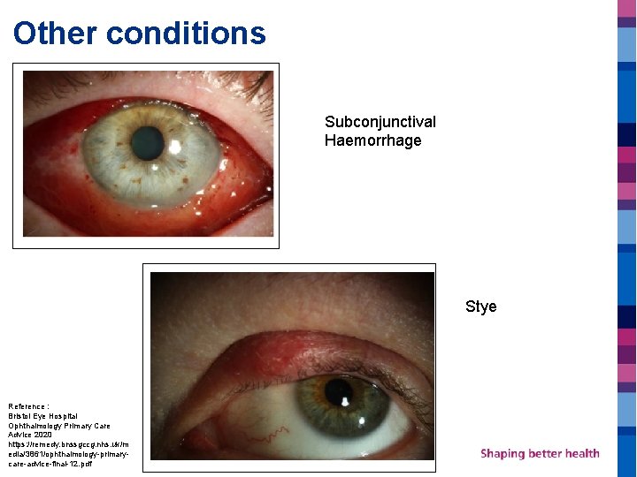 Other conditions Subconjunctival Haemorrhage Stye Reference : Bristol Eye Hospital Ophthalmology Primary Care Advice
