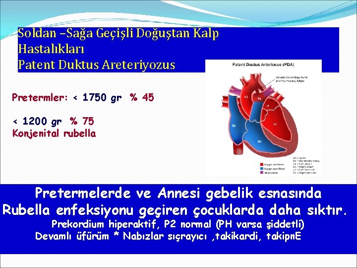 Soldan –Sağa Geçişli Doğuştan Kalp Hastalıkları Patent Duktus Areteriyozus Pretermler: < 1750 gr %