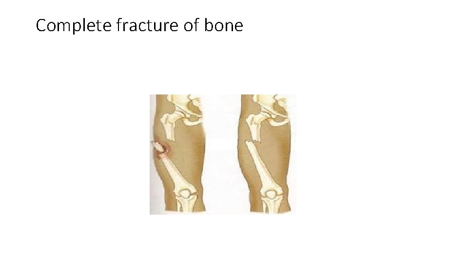 Complete fracture of bone 