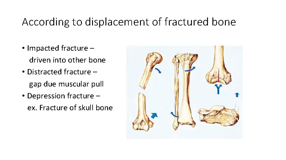 According to displacement of fractured bone • Impacted fracture – driven into other bone