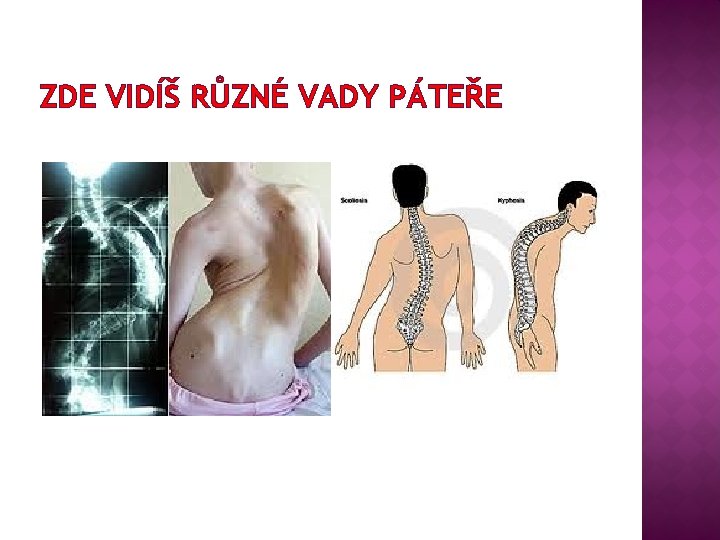 ZDE VIDÍŠ RŮZNÉ VADY PÁTEŘE 