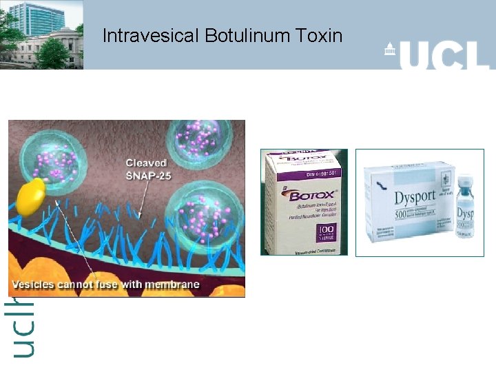 Intravesical Botulinum Toxin 