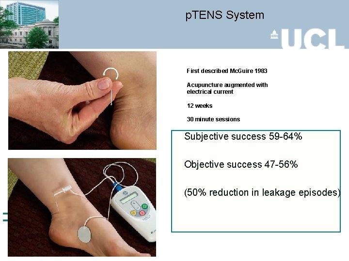 p. TENS System First described Mc. Guire 1983 Acupuncture augmented with electrical current 12