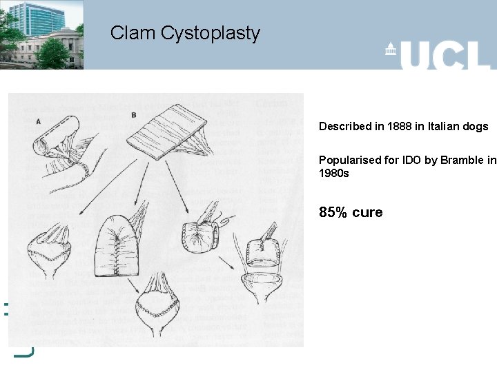 Clam Cystoplasty Described in 1888 in Italian dogs Popularised for IDO by Bramble in