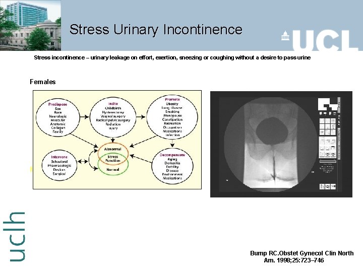 Stress Urinary Incontinence Stress incontinence – urinary leakage on effort, exertion, sneezing or coughing