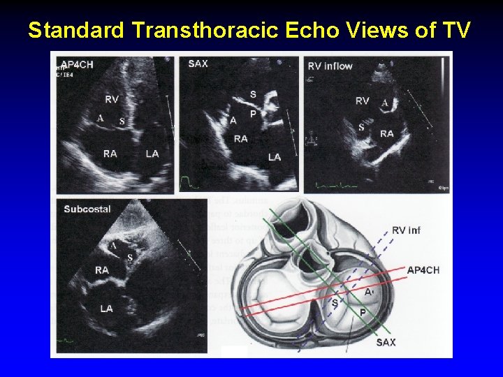 Standard Transthoracic Echo Views of TV Standard Transthoracic Echo Views of TV
