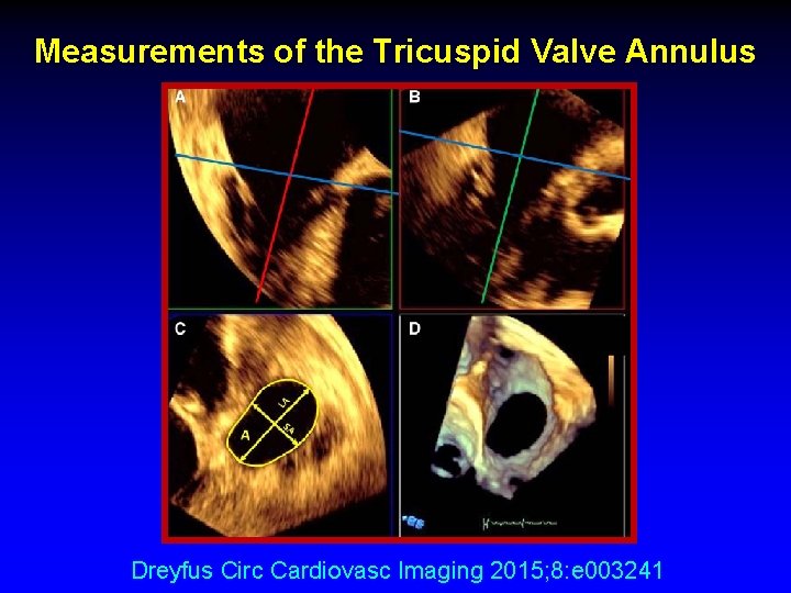 Measurements of the Tricuspid Valve Annulus Dreyfus Circ Cardiovasc Imaging 2015; 8: e 003241 Measurements of the Tricuspid Valve Annulus Dreyfus Circ Cardiovasc Imaging 2015; 8: e 003241