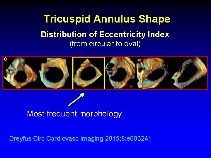 Tricuspid Annulus Shape Distribution of Eccentricity Index (from circular to oval) Most frequent morphology Tricuspid Annulus Shape Distribution of Eccentricity Index (from circular to oval) Most frequent morphology