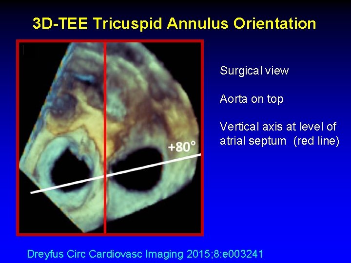 3 D-TEE Tricuspid Annulus Orientation Surgical view Aorta on top Vertical axis at level 3 D-TEE Tricuspid Annulus Orientation Surgical view Aorta on top Vertical axis at level