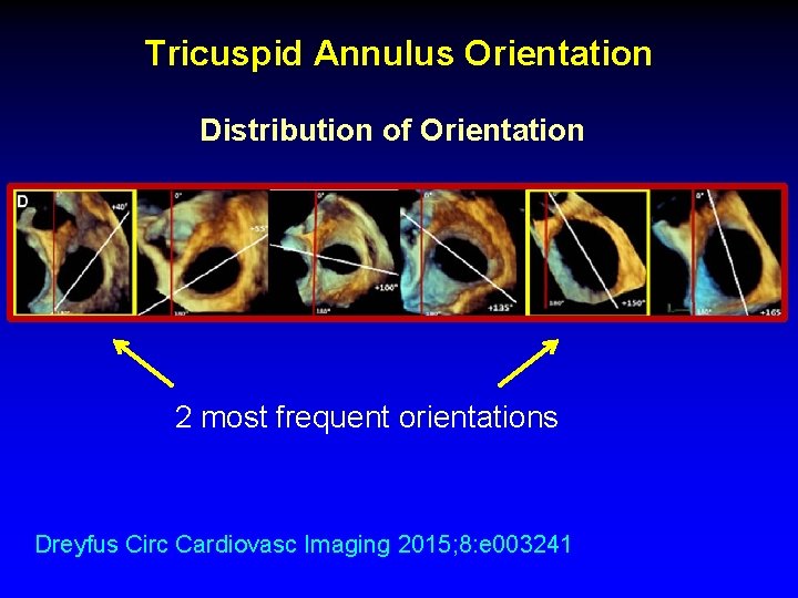 Tricuspid Annulus Orientation Distribution of Orientation 2 most frequent orientations Dreyfus Circ Cardiovasc Imaging Tricuspid Annulus Orientation Distribution of Orientation 2 most frequent orientations Dreyfus Circ Cardiovasc Imaging
