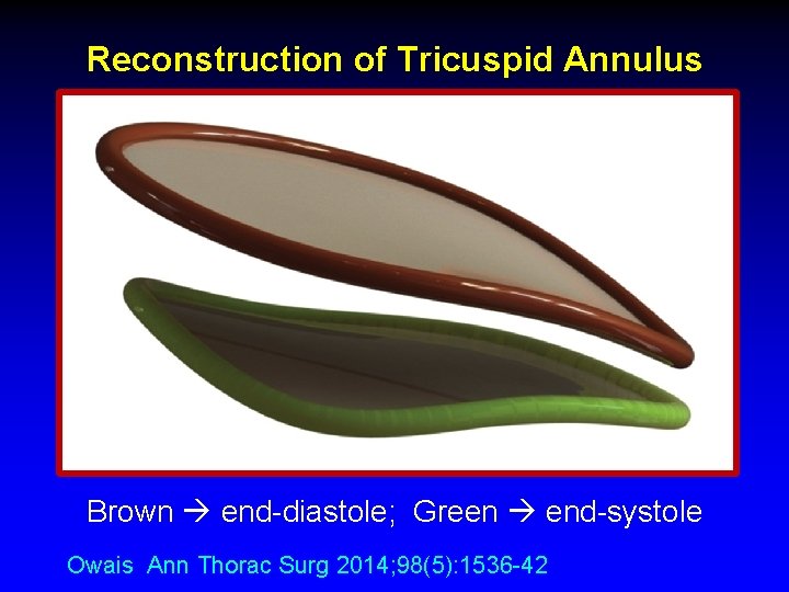 Reconstruction of Tricuspid Annulus Brown end-diastole; Green end-systole Owais Ann Thorac Surg 2014; 98(5): Reconstruction of Tricuspid Annulus Brown end-diastole; Green end-systole Owais Ann Thorac Surg 2014; 98(5):