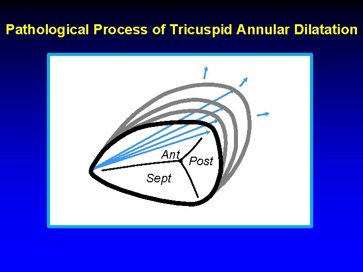Pathological Process of Tricuspid Annular Dilatation Ant Sept Post Pathological Process of Tricuspid Annular Dilatation Ant Sept Post