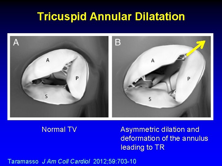 Tricuspid Annular Dilatation Normal TV Asymmetric dilation and deformation of the annulus leading to Tricuspid Annular Dilatation Normal TV Asymmetric dilation and deformation of the annulus leading to