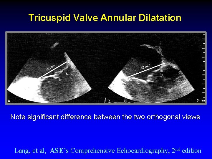 Tricuspid Valve Annular Dilatation Note significant difference between the two orthogonal views Lang, et Tricuspid Valve Annular Dilatation Note significant difference between the two orthogonal views Lang, et