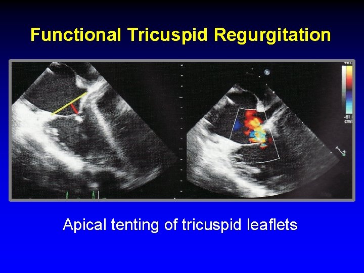 Functional Tricuspid Regurgitation Apical tenting of tricuspid leaflets Functional Tricuspid Regurgitation Apical tenting of tricuspid leaflets