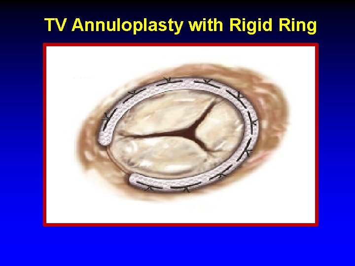 TV Annuloplasty with Rigid Ring TV Annuloplasty with Rigid Ring