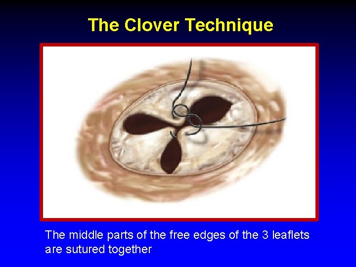 The Clover Technique The middle parts of the free edges of the 3 leaflets The Clover Technique The middle parts of the free edges of the 3 leaflets